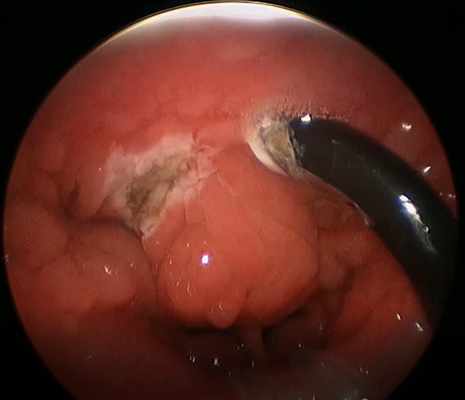 varinha do diâmetro PLA402 Tonsilectomy de 4.4mm para a cirurgia médica
