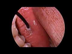 Gerador de Plasma de Radiofrequência para Tratamento de Ronco com Sonda Multifuncional