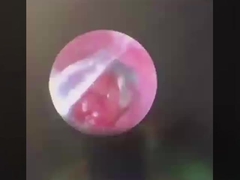 Butterfly ENT Instrumentos de cirurgia ENT sonda