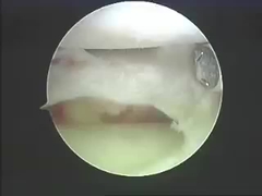 Produtos da ablação dos sistemas da ablação dos instrumentos de Electrosurgical para a espinha e as junções