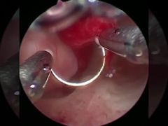 Tecnologia Frio Electrodo de Cirurgia de Plasma Para Procedimentos de Urologia BPH