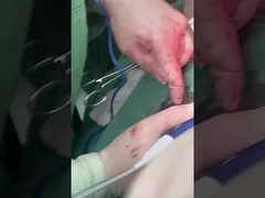 Proba de hepatologia clínica PLA408 para cirurgia aberta